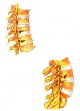 Spinal osteokondrozun illüstrasyonu